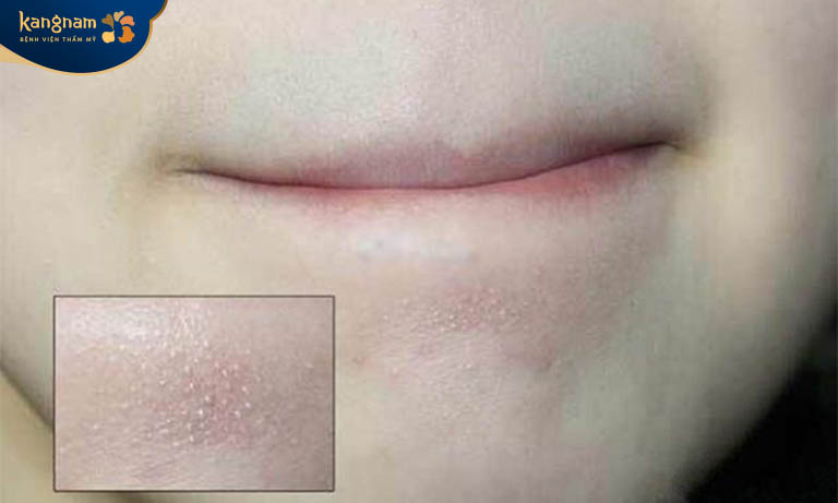 Mụn cám không tự hết được nếu bạn không có cách điều trị phù hợp