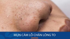 15 bí quyết đánh bay mụn cám, se khít lỗ chân lông hiệu quả tại nhà