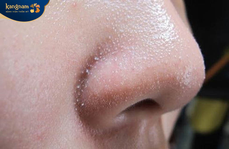 Mụn cám thường mọc ở má, mũi, cằm, trán