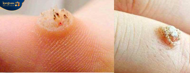 Mụn cóc có thể mọc ở bàn tay, móng tay, lòng bàn chân, móng chân