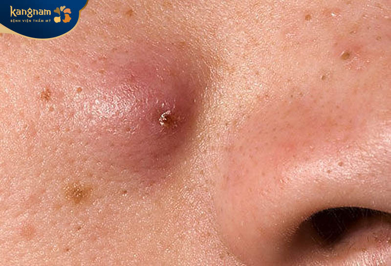 Mụn đinh râu hình thành từ gốc chân của sợi râu