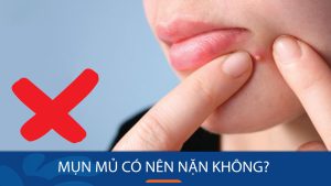 Mụn mủ có nên nặn không? Nặn mụn mủ đúng cách để da sáng mịn, không thâm sẹo