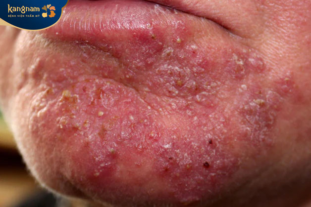 Nặn mụn mủ sai cách còn khiến kích thích vào da gây viêm nhiễm