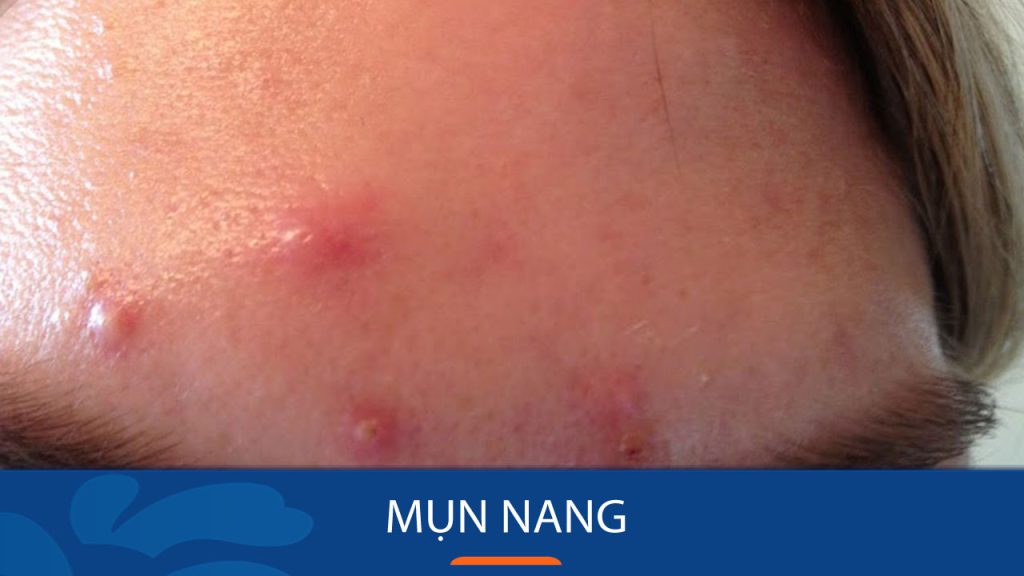 Mụn nang: Nguyên nhân, triệu chứng và cách điều trị hiệu quả