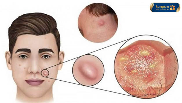 Cơ chế hình thành mụn nang