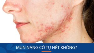Mụn nang có tự hết không? Cách điều trị hiệu quả