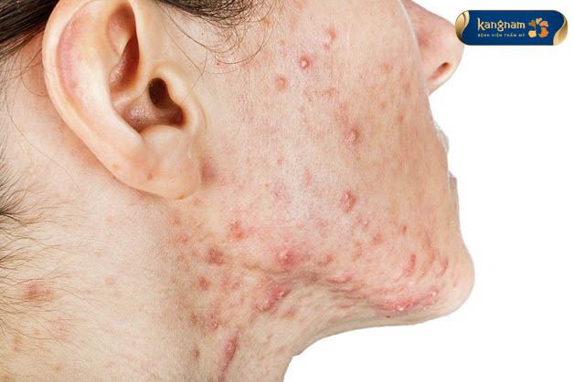 Mụn nang có tự hết không? Chuyên gia lý giải: Không tự hết