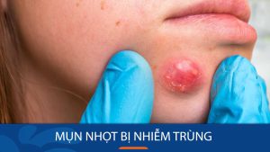 Mụn nhọt sưng tấy, đau nhức? Đừng lo! Cách trị mụn nhọt bị nhiễm trùng tại nhà