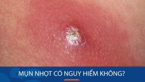 Mụn nhọt có nguy hiểm không? Đừng chủ quan, hãy bảo vệ sức khỏe của bạn!