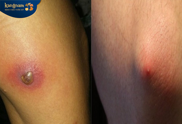 thực tế mụn nhọt không gây nguy hiểm trực tiếp đến sức khỏe