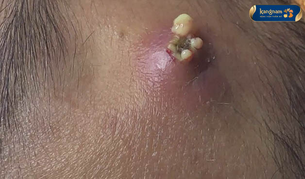 Mụn thiết nhiều mủ và dịch