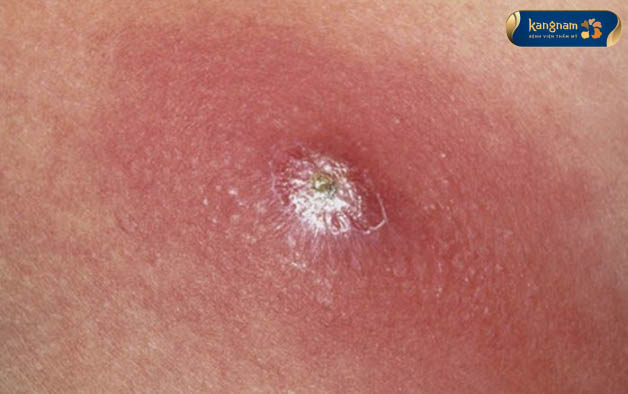 Mụn gây đau nhiều, khiến người bệnh khó chịu