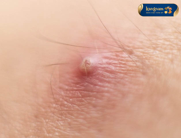 Mụn nhọt bị nhiễm trùng gây đủ và sưng ở vùng mụn
