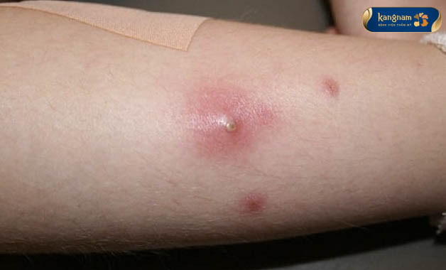 Các triệu chứng của mụn nhọt ở chân