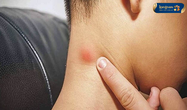 Triệu chứng của mụn nhọt mọc ở vị trí sau gáy