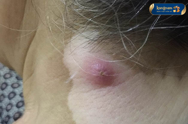 Điều trị mụn nhọt không đúng cách có thể gây ra biến chứng