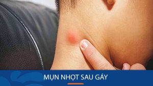 Mụn nhọt sau gáy: Bí quyết loại bỏ mụn nhọt sau gáy tận gốc