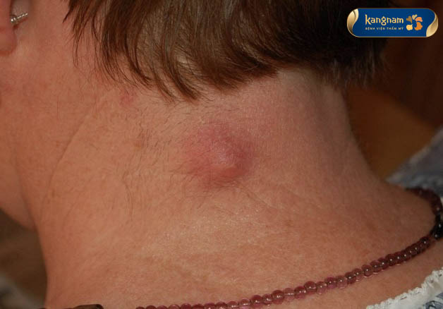 Mụn nhọt mọc sau gáy hình thành do nhiều nguyên nhân khác nhau