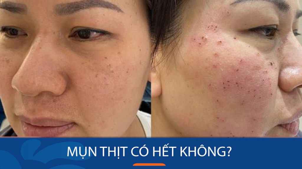 Mụn thịt có hết không? Bí quyết loại bỏ mụn thịt tận gốc, trả lại làn da mịn màng!