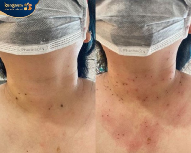 Điều trị mụn thịt ở cổ bằng phương pháp Laser CO2 Fractional