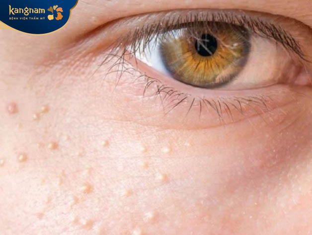 Mụn thịt hình thành như thế nào