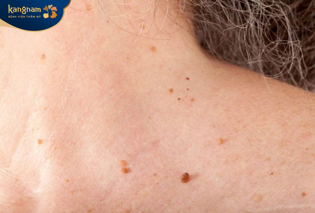 Nặn mụn thịt khiến nốt mụn lan ra các vùng da khác