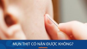 Mụn thịt nặn được không? Cách nặn mụn thịt an toàn và hiệu quả tại nhà