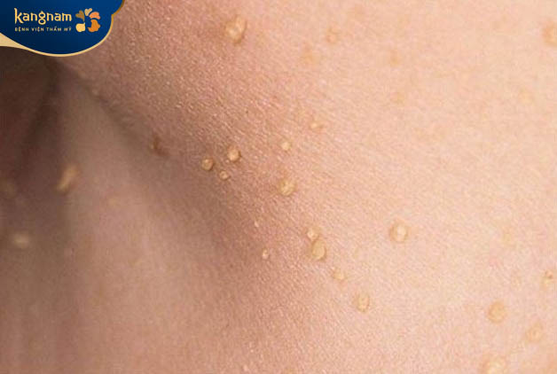 Mụn thịt có tự khỏi không