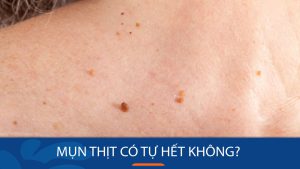Mụn thịt có tự hết không? Bí quyết loại bỏ mụn thịt tận gốc