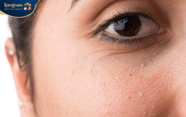 Thay đổi nội tiết tố trong cơ thể có thể gây nên tình trạng mụn thịt