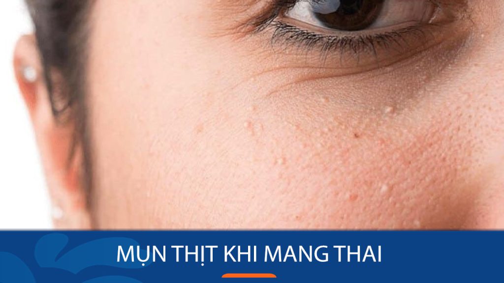 Cách điều trị mụn thịt khi mang thai an toàn và ngăn ngừa tái phát