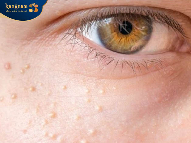 Mụn thịt khi mang thai do tác động bên ngoài