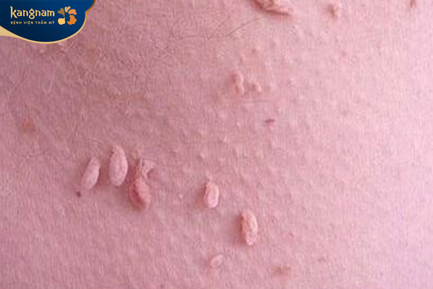 Đa phần mụn thịt mọc dưới chân đều lành tính