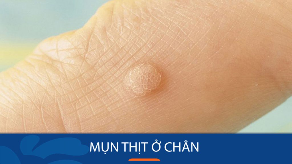Mụn thịt ở chân: Nguyên nhân, triệu chứng và cách điều trị hiệu quả