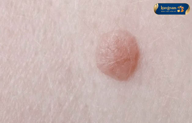 Mụn thịt ở háng có đầu mụn màu hồng nhạt