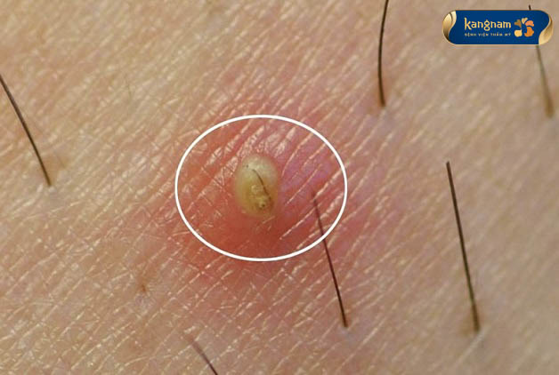 Mụn thịt là dấu hiệu của viêm nang lông