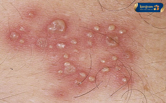 Bệnh tràm có các dấu hiệu như mụn thịt