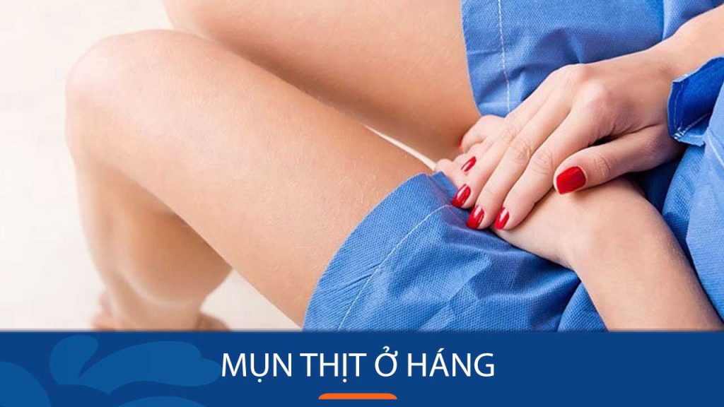 Loại bỏ mụn thịt ở háng vĩnh viễn: 5 phương pháp hiệu quả nhất