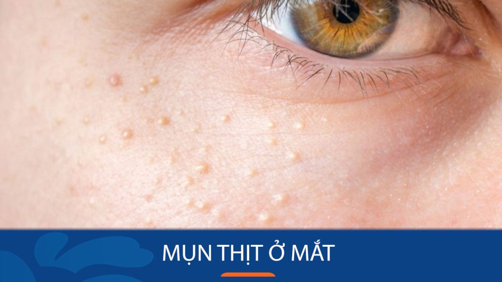 Bí quyết loại bỏ mụn thịt ở mắt nhanh chóng, an toàn tại nhà