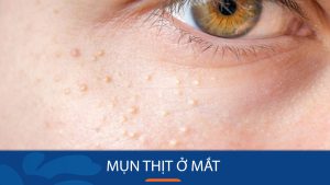 Bí quyết loại bỏ mụn thịt ở mắt nhanh chóng, an toàn tại nhà