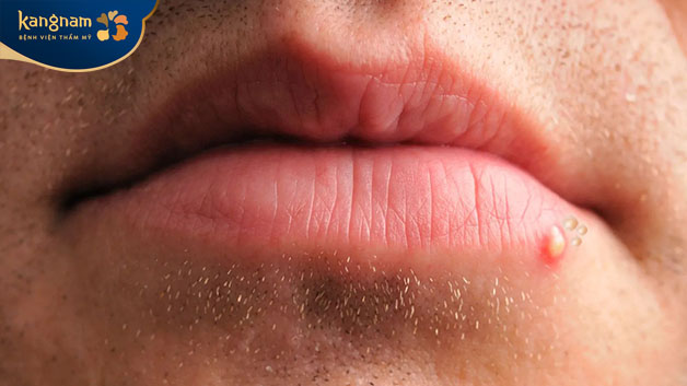 Nội tiết tố trong cơ thể thay đổi cũng làm mụn thịt nổi lên 