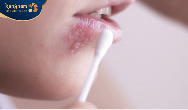 Với những nốt mụn nhỏ và ít có thể sử dụng thuốc bôi hoặc uống 