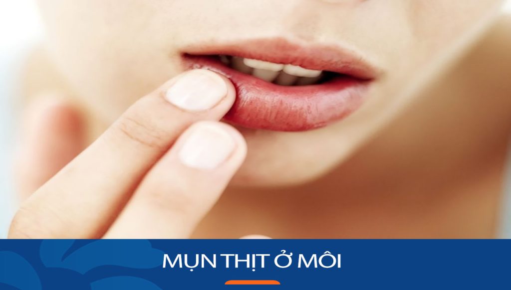 Mụn thịt ở môi là gì? Mụn thịt ở môi có nguy hiểm không?