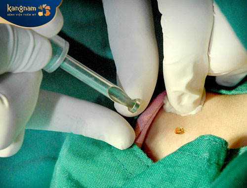 Phẫu thuật điều trị mụn thịt