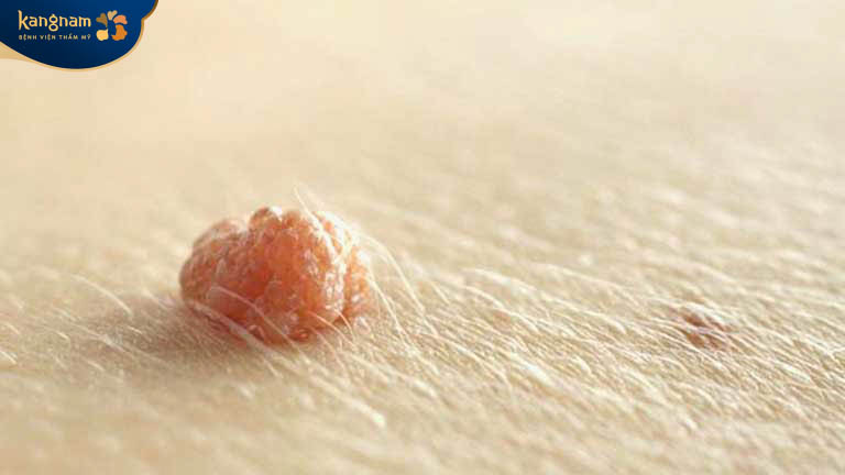 Mụn thịt ở nách