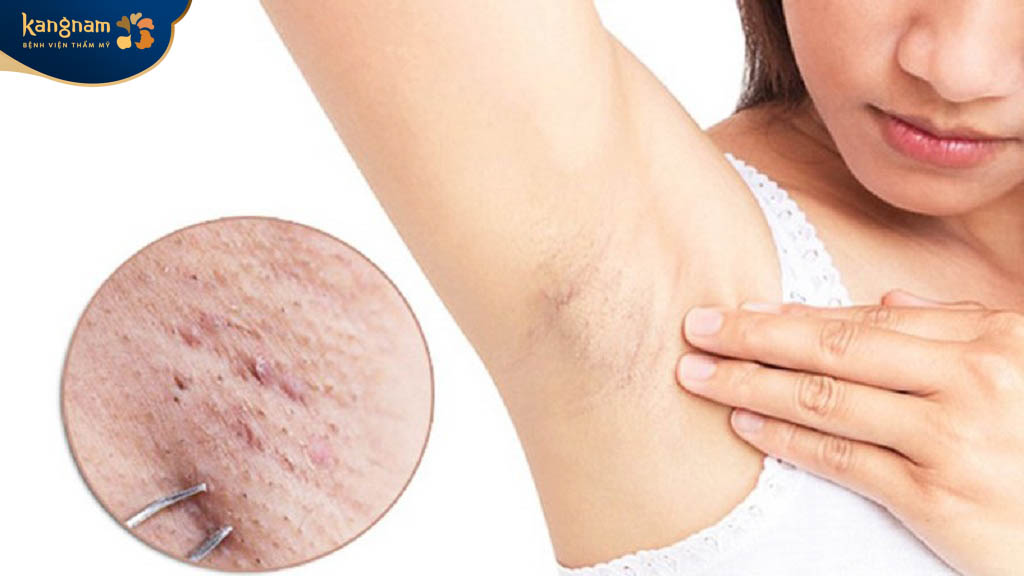 Mụn thịt ở nách do rối loạn tuyến mồ hôi
