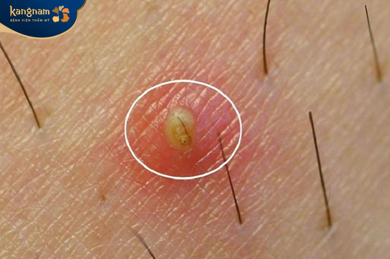 Tình trạng viêm nang lông gây sưng đỏ, nổi mụn thịt