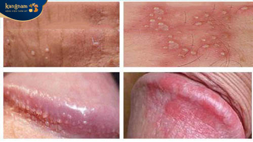 Mụn thịt ở vùng kín do sùi mào gà