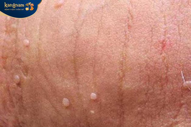 Người có tiền sử gia đình bị mụn thịt