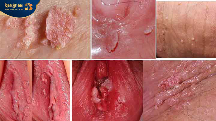 Viêm âm đạo gây mụn thịt ở vùng kín